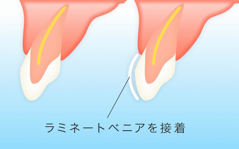 歯の表面に貼る薄い被せもの（ラミネートベニア）