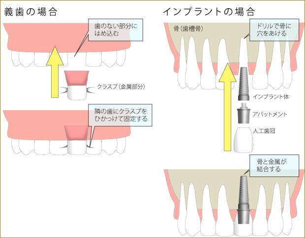 義歯（部分入れ歯）との比較