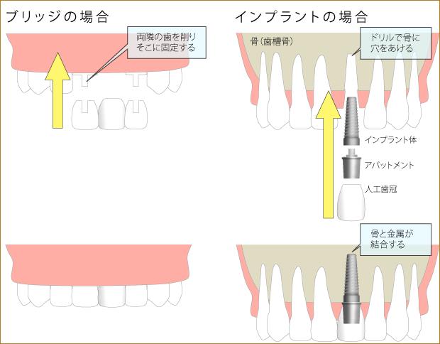 ブリッジとの比較